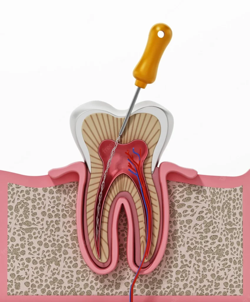 root-canal-treatment